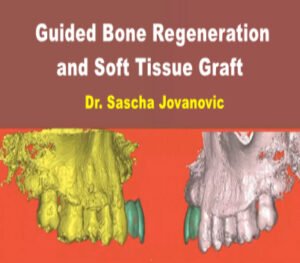 Guided Bone Regeneration and Soft Tissue Graft